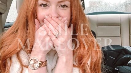 My Smile Makeover | Before & After Porcelain Veneers