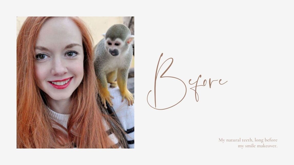 My teeth before smile makeover